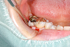 HP4：局所再生療法（歯周外科）スライド52術中2