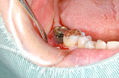 HP4：局所再生療法（歯周外科）スライド52術中3