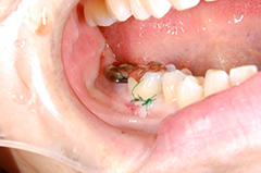 HP4：局所再生療法（歯周外科）スライド52術中4
