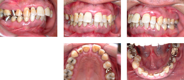 歯周病治療（保険診療）中等度から重度歯周病
