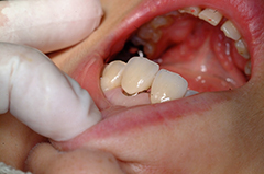 HP4：前歯部ジルコニア2（歯肉トリートメント）40代女性5