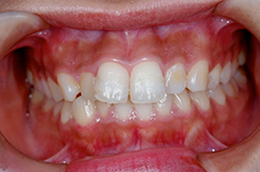 HP4：前歯部ジルコニア2（歯肉トリートメント）40代女性1