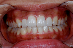 HP4：前歯部ジルコニア2（歯肉トリートメント）40代女性3