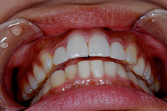 HP4：前歯部ジルコニア2（歯肉トリートメント）40代女性4