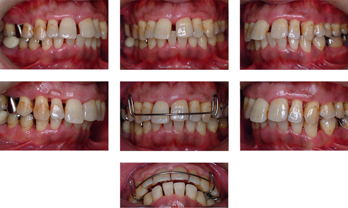 歯周基本治療及び歯列不正の改善