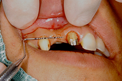 HP4：前歯部ジルコニアブリッジ4（歯肉移植→歯槽増大）30代女性2