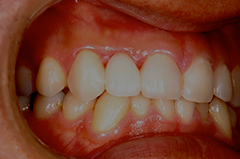 HP4：前歯部ジルコニアブリッジ4（歯肉移植→歯槽増大）30代女性4
