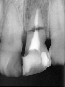 HP3：前歯部インプラント治療（歯根破折）30代男性2