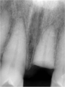 前歯部インプラント治療2,（打撲による歯冠破折）60代男性2
