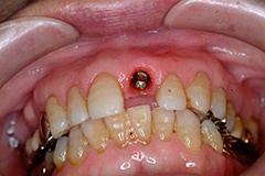 前歯部インプラント治療2,（打撲による歯冠破折）60代男性3
