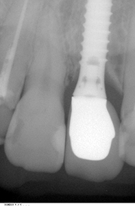 HP3：前歯部インプラント治療（虫歯による歯根吸収）20代女性2
