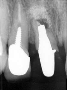 HP3：前歯部インプラント治療（虫歯による歯根吸収）20代女性6