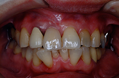 HP3：前歯部インプラント治療（虫歯による歯根吸収）20代女性7