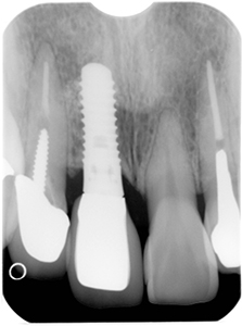 HP3：前歯部インプラント治療（虫歯による歯根吸収）20代女性8