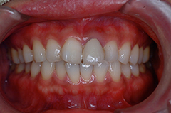 HP4：前歯部インプラント&ジルコニア（歯根破折）30代女性1