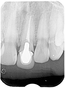 HP4：前歯部インプラント&ジルコニア（歯根破折）30代女性2