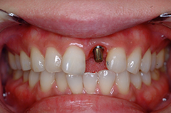 HP4：前歯部インプラント&ジルコニア（歯根破折）30代女性3