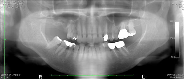 HP4：ガイデッドサージェリー1（右上欠損及び歯槽骨非薄）60代女性2