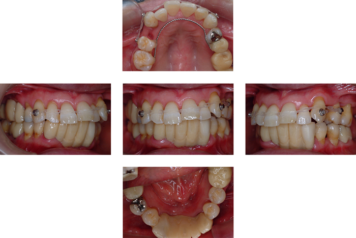 歯周基本治療後の小矯正治療