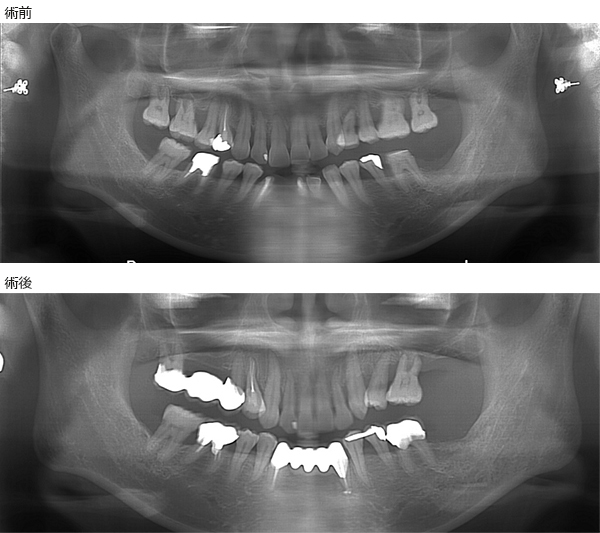 スライド29術前術後X線
