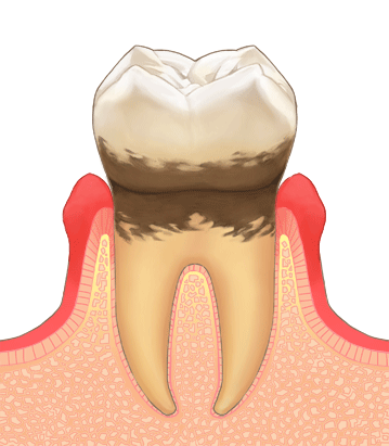 軽度歯周病