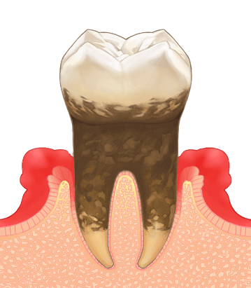 中等度歯周病